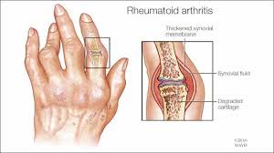 CONVENTIONAL THERAPY FOR EARLY INFLAMMATORY ARTHRITIS DOES NOT MODIFY PERIPHERAL BLOOD CYTOKINE PROFILES. In RHEUMATOLOGY